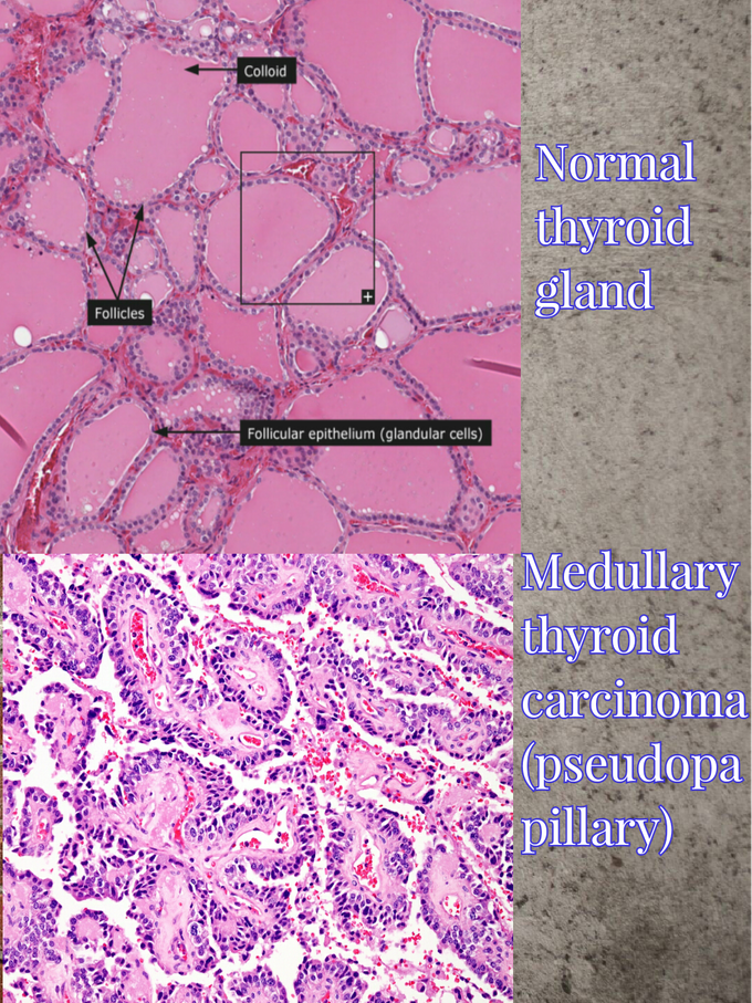 medullary-thyroid-carcinoma-pseudopapillary-medizzy