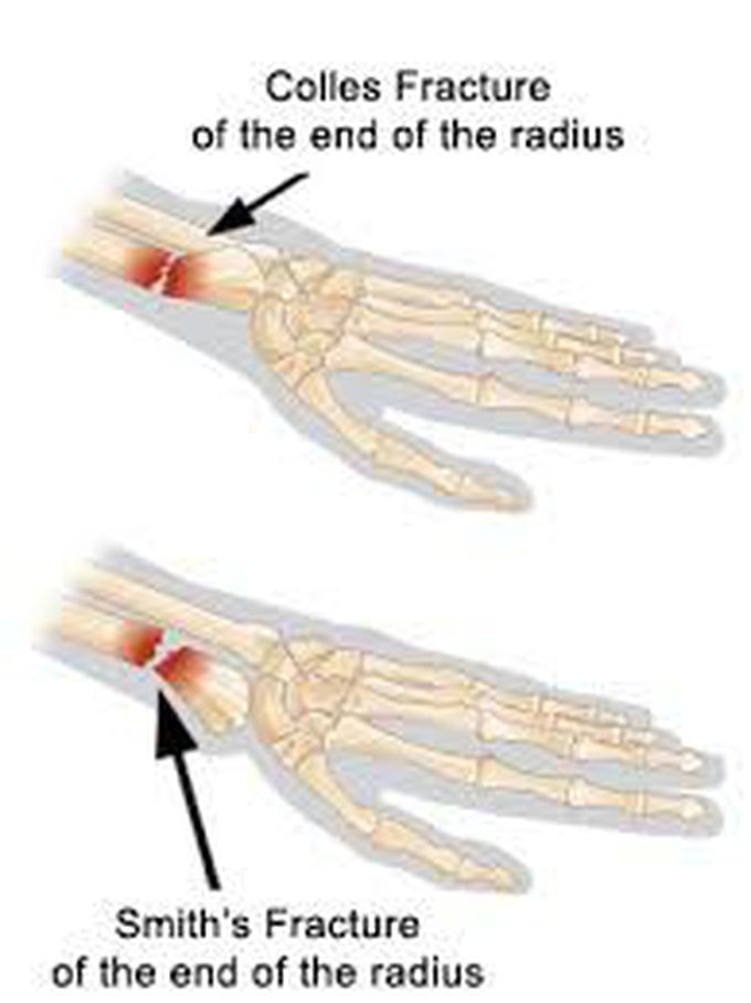 Colles and Smith's fracture