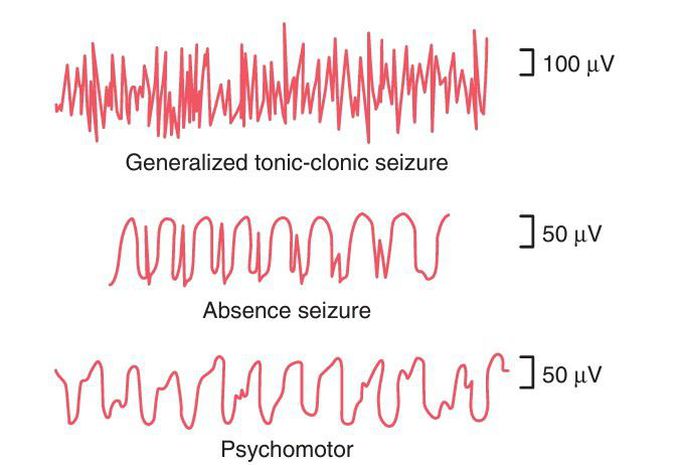 Epilepsy