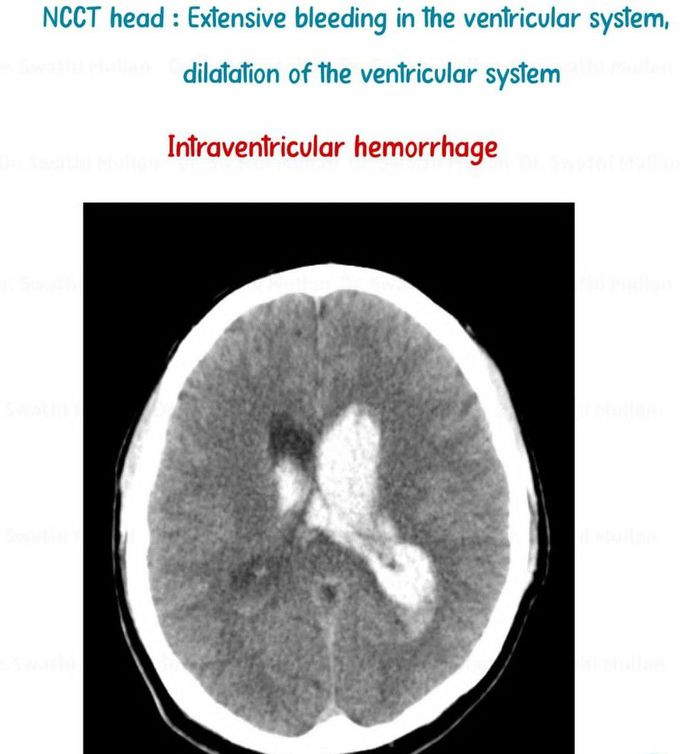 Intraventricular Hemorrhage