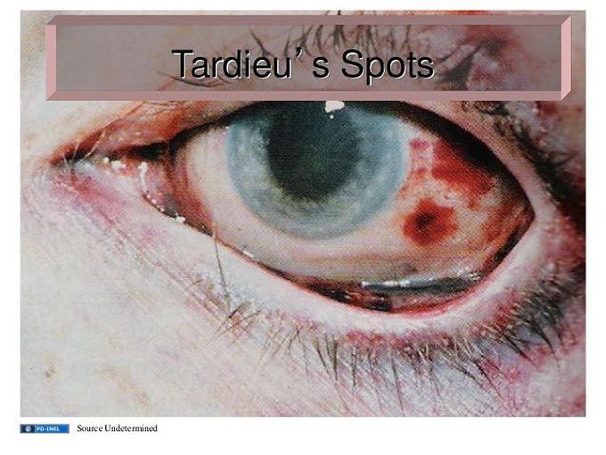 Tardieu's Spots