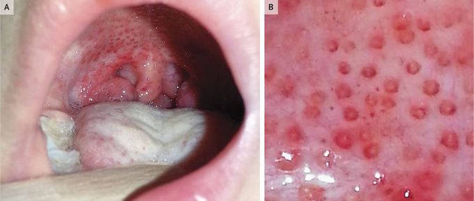 “Doughnut” Lesions