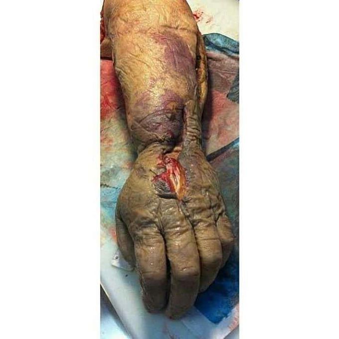 Necrosis due to IV drug use error