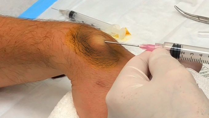 Ganglion Cyst Drained with BIG Needle - Neck Surgery Update
