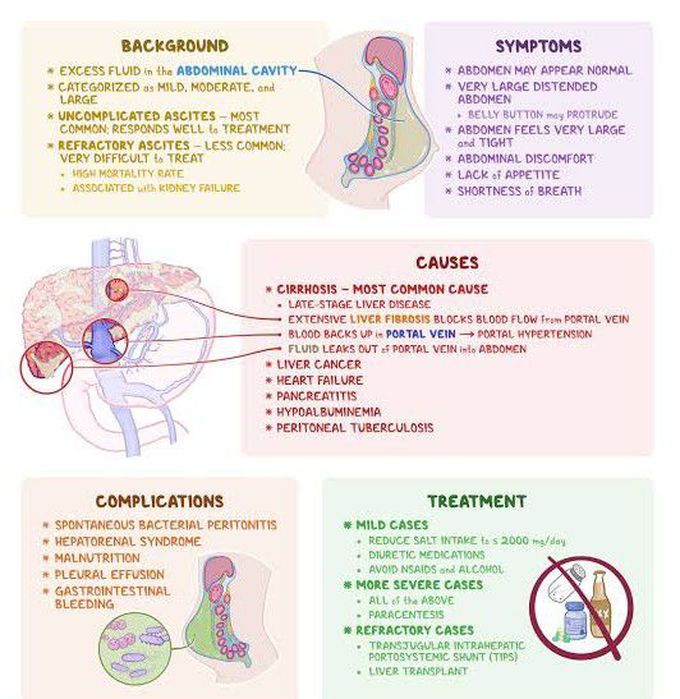 Ascites - MEDizzy