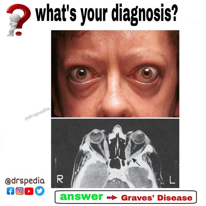 Graves’ Disease