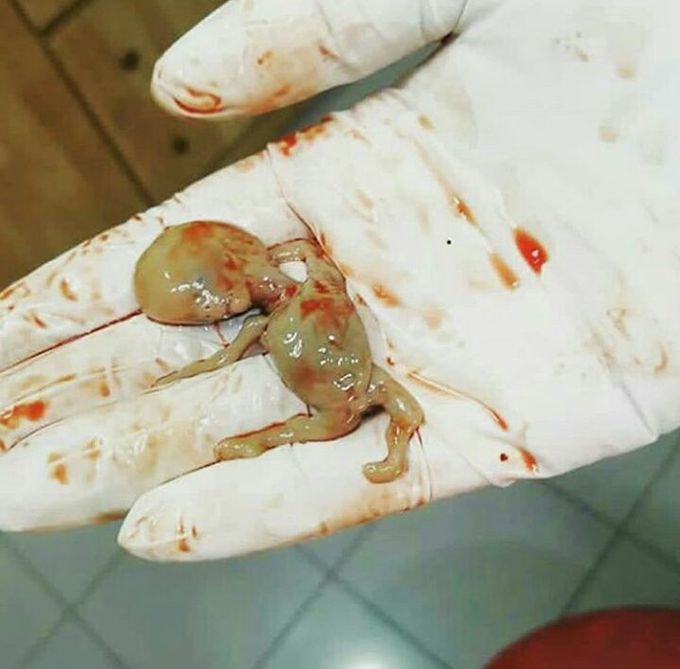 Ectopic pregnancy!!