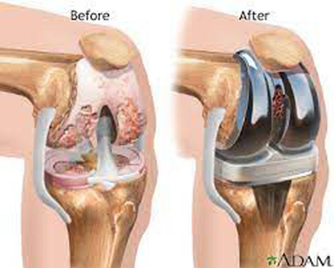 Complications with Total Joint Replacement Surgery
