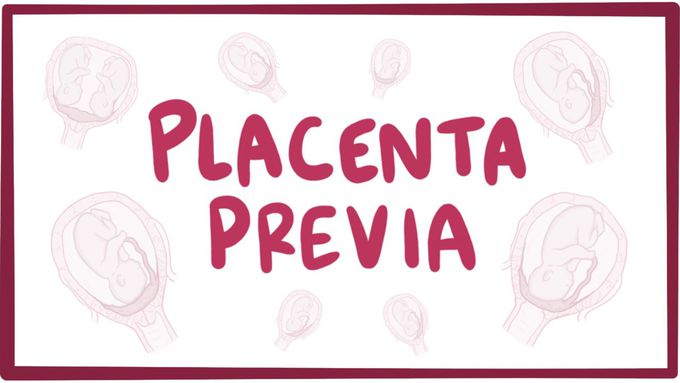Placenta previa - causes, symptoms, diagnosis, treatment, pathology
