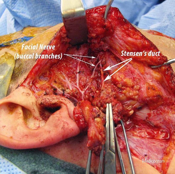 Parotid gland surgery