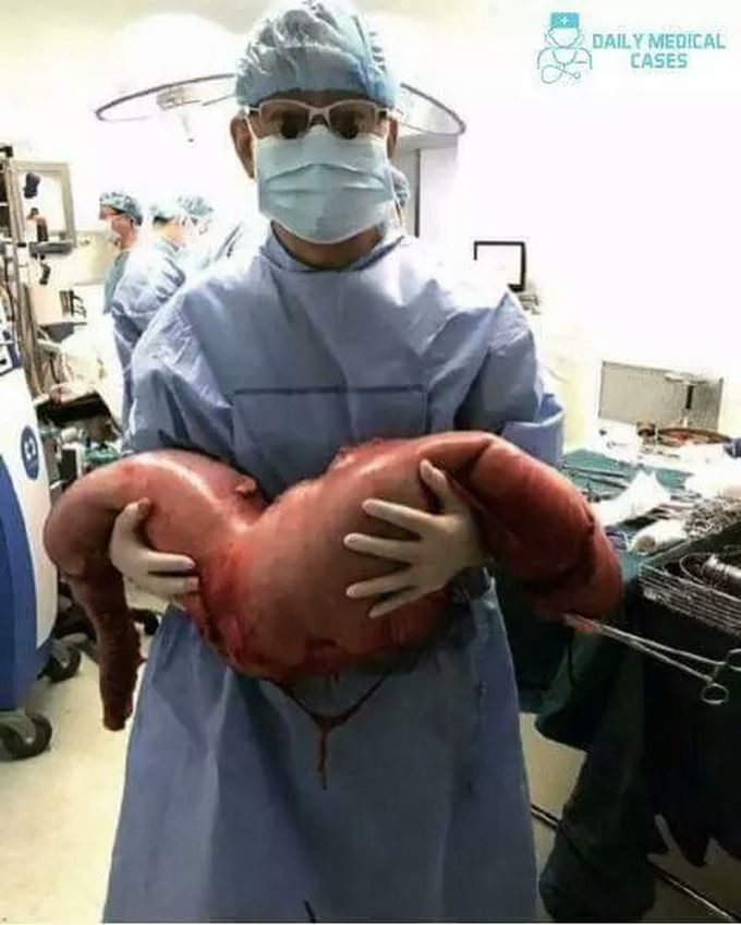 Hirschsprung disease...