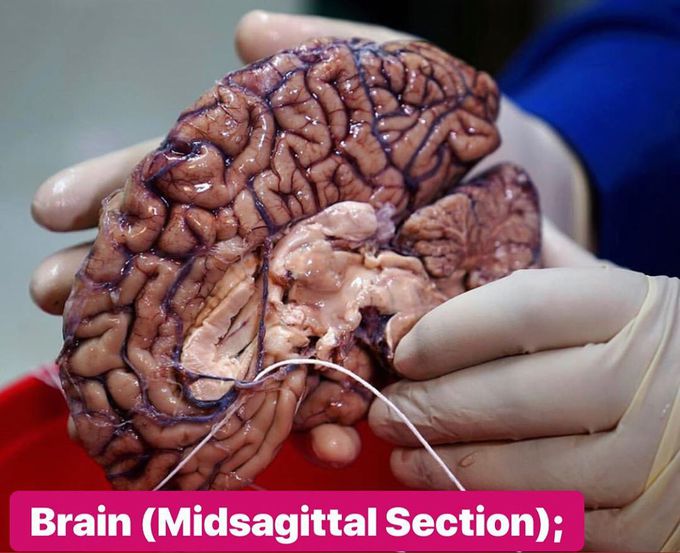 Midsagittal section of the brain