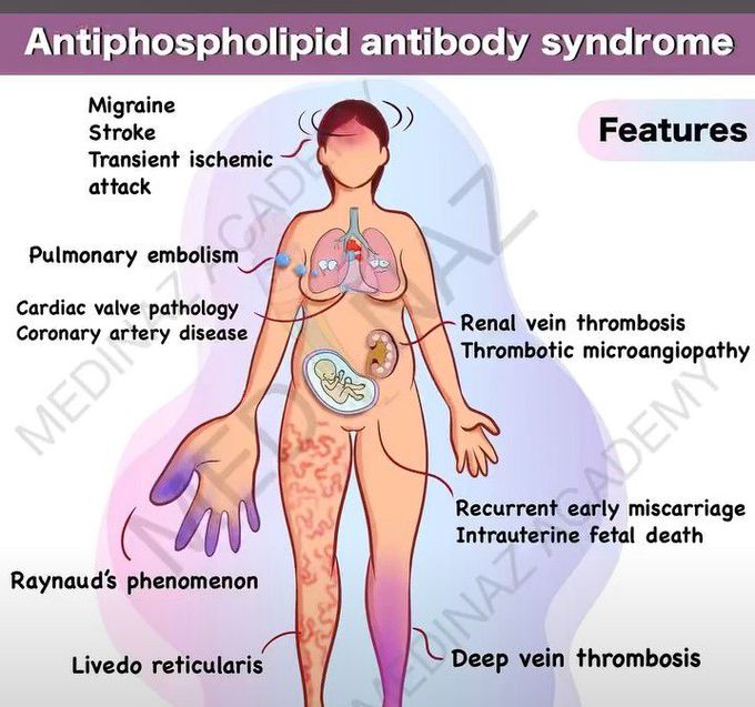 Antiphospholipid Antibody Syndrome-Features