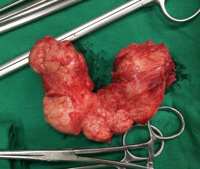 Prostate enlargement