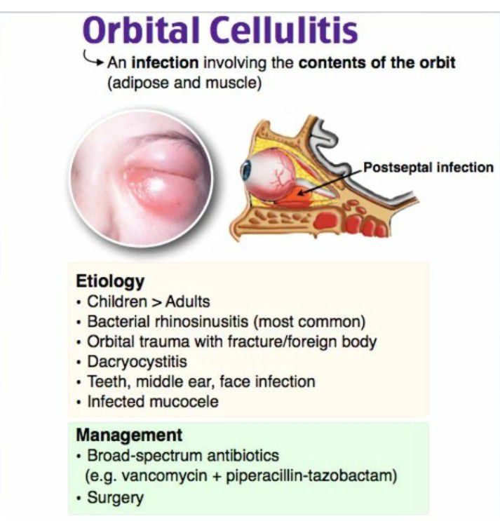 anatomy orbital cellulitis