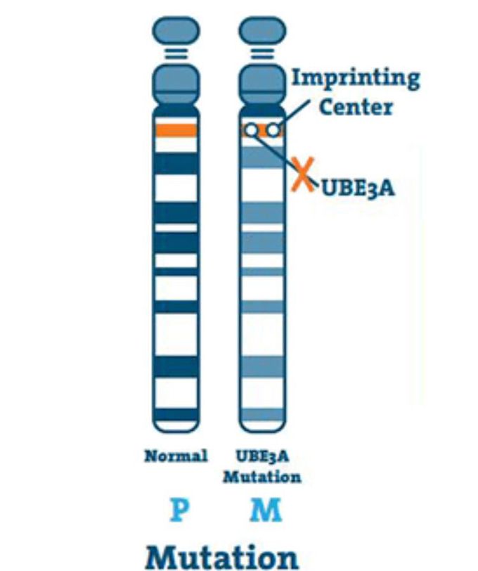 Angelman syndrome