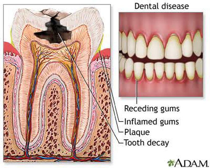 Symptoms of gingivostomatitis