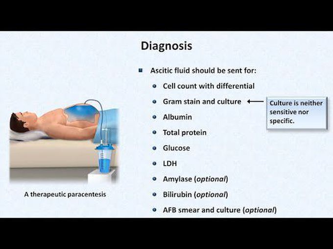 Spontaneous Bacterial Peritonitis: Overview
