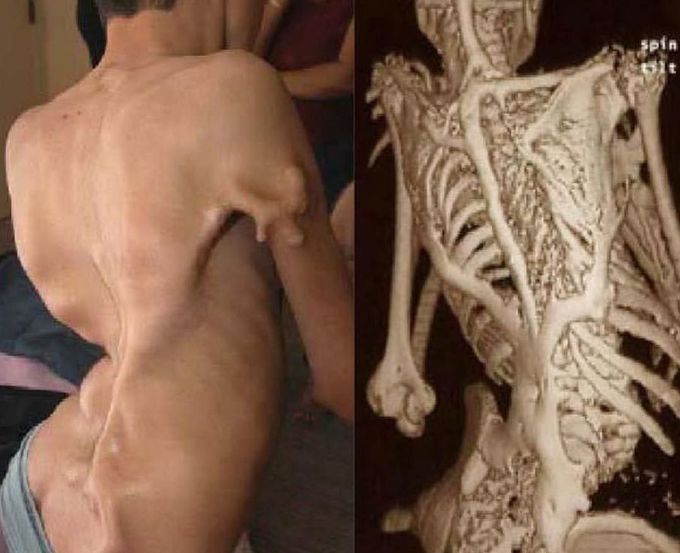 Case of Fibrodysplasia Ossificans Progressiva.