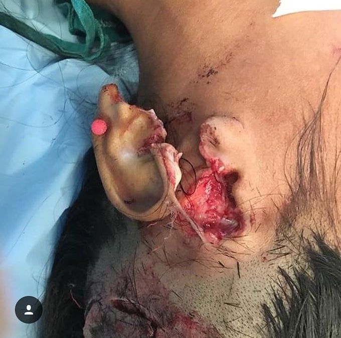 Ear evulsion after bears bite🐻