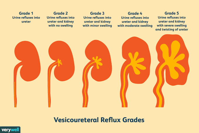 Vesicoureteral Reflux