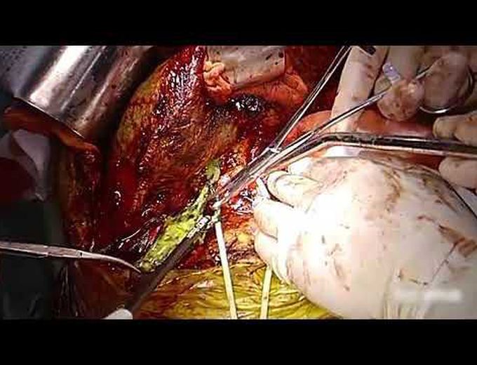 Biliary Cast Syndrome