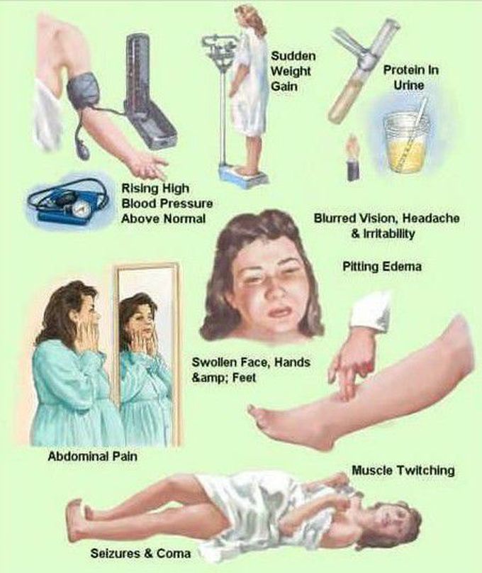 PREECLAMPSIA  and ECLAMPSIA