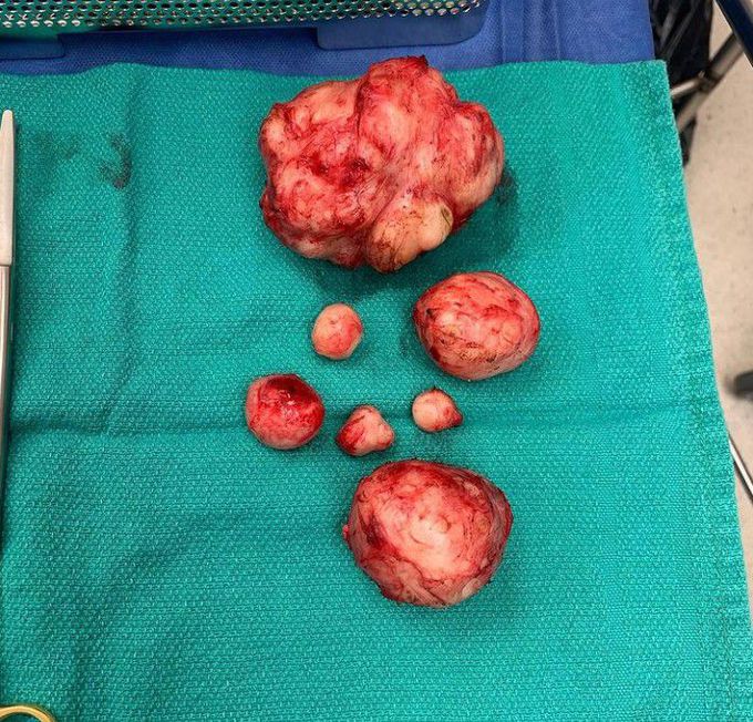 Uterine Fibroids
