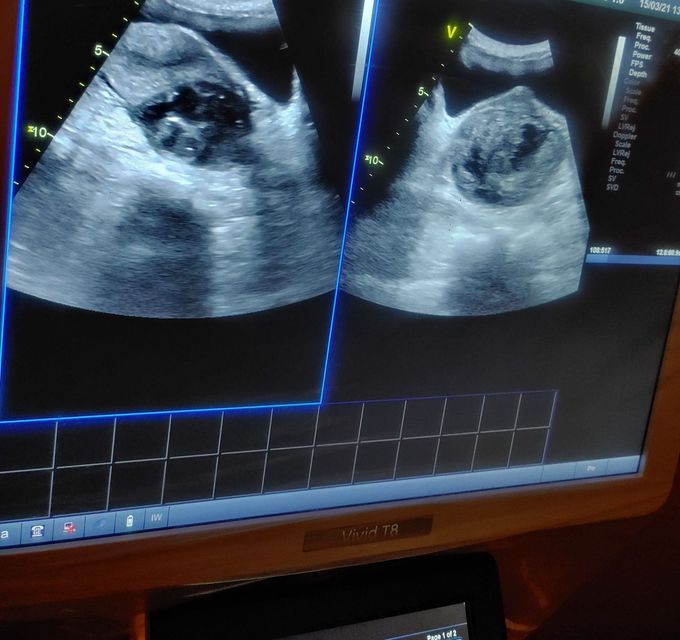 Female of age complaining stomach pain came to hospital doctor done ultra sound abdomen it results fibroids in abdomen