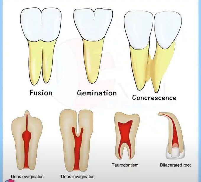 fusion teeth