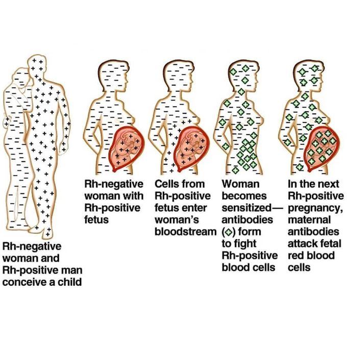 Haemolytic disease of newborn