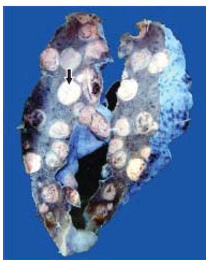 Metastatic deposits in the lung