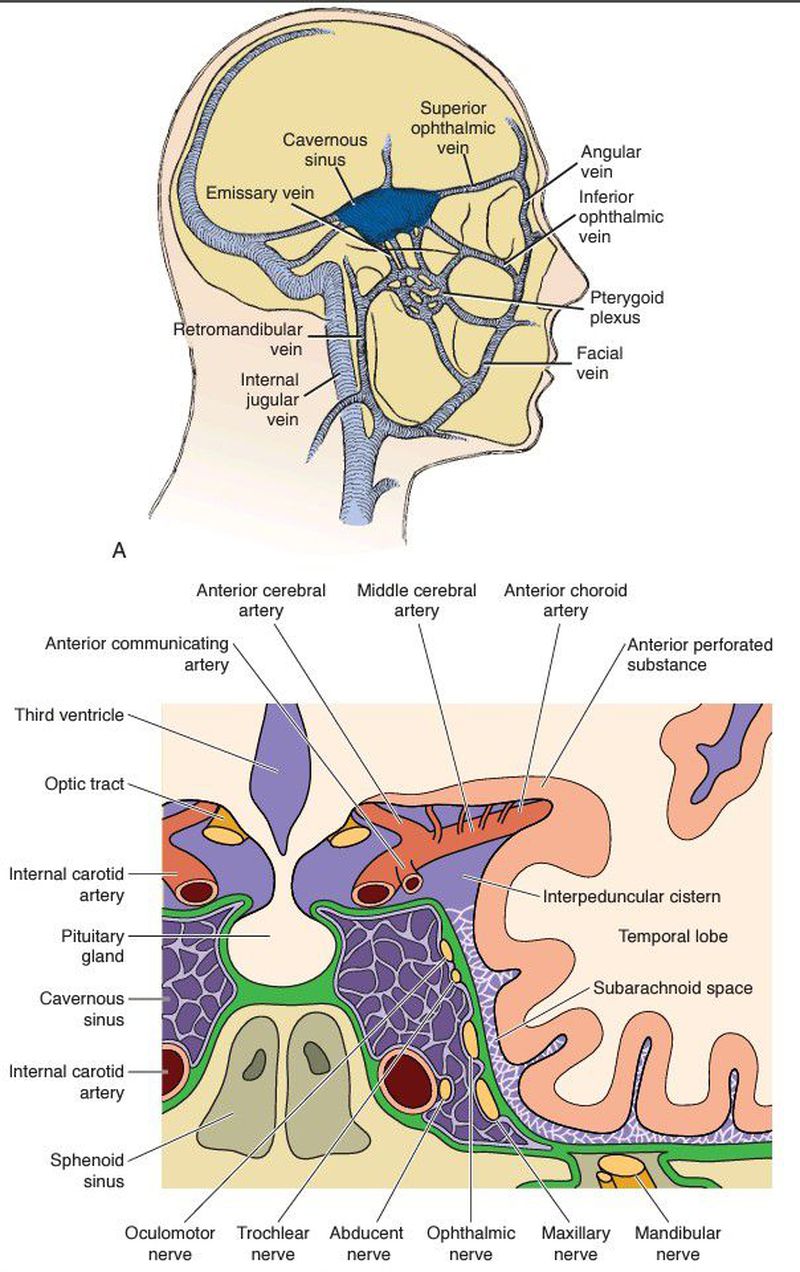 Cavernous sinus infection - MEDizzy