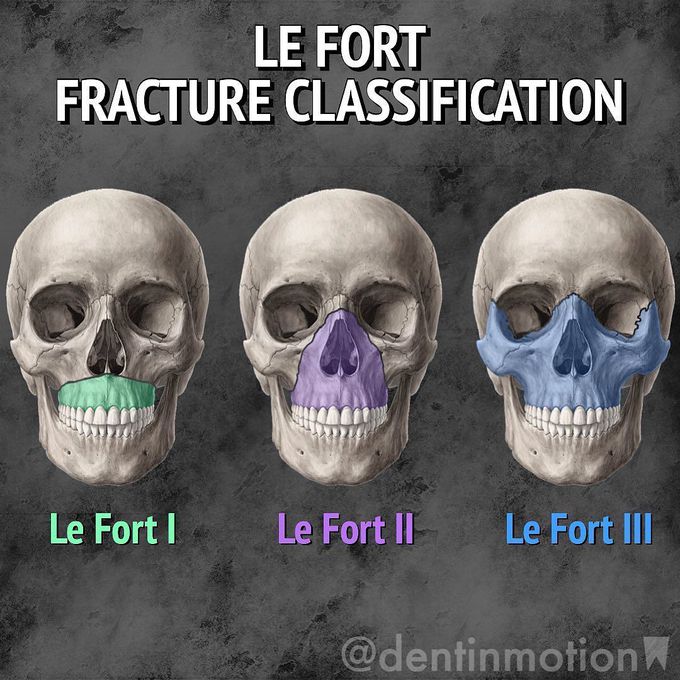 Le Fort Fracture Classification