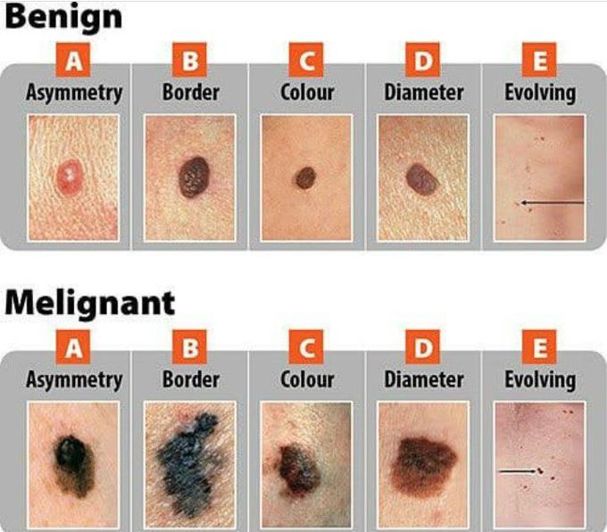 ABCDE to differentiate between benign and melignant mole