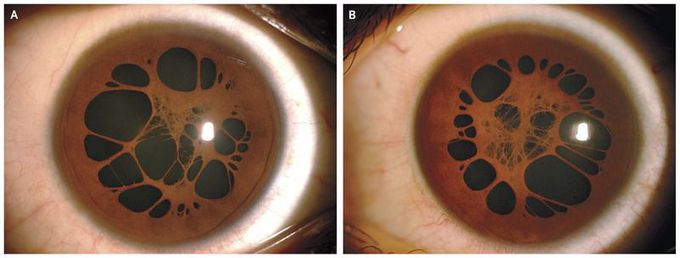 Persistent Pupillary Membrane