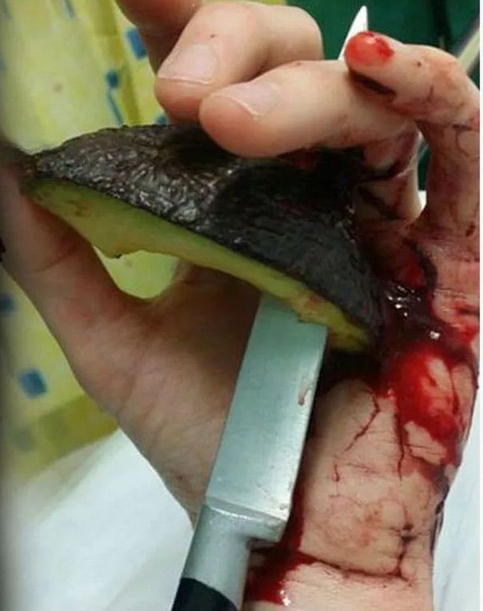 Be careful while preparing avocado!