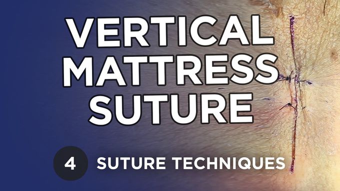 Vertical Mattress Suture