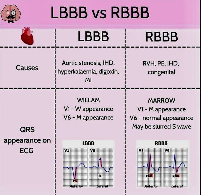 LBBB Vs RBBB