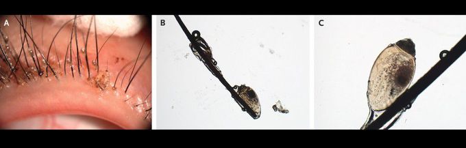 Phthiriasis Palpebrarum