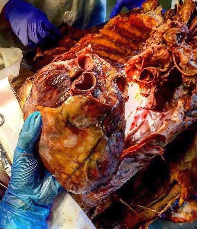 Human heart