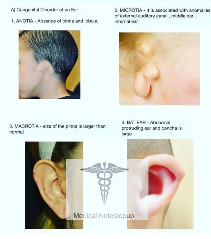 Outer Ear Pathologies- II
