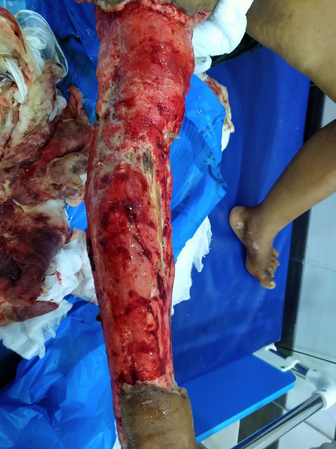 Road traffic accident (RTA)