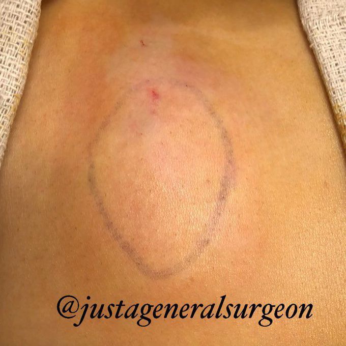 Lipoma