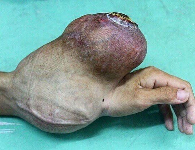Untreated giant cell tumor of the lower arm!