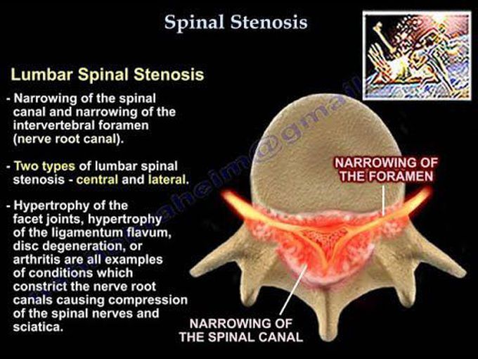 Lumbar Spinal Stenosis - Everything You Need To Know