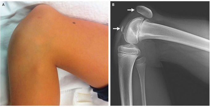 Patellar Fracture with Sleeve Avulsion