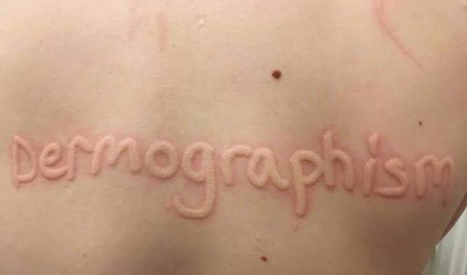 Dermatographism