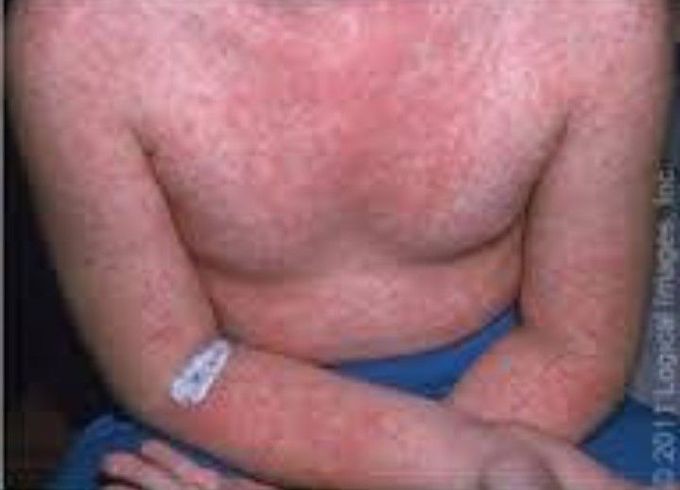 Red man syndrome.Caused by which drug?can be treated by?
