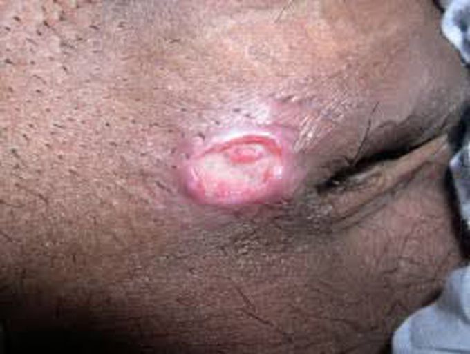 Symptoms of granuloma inguinale